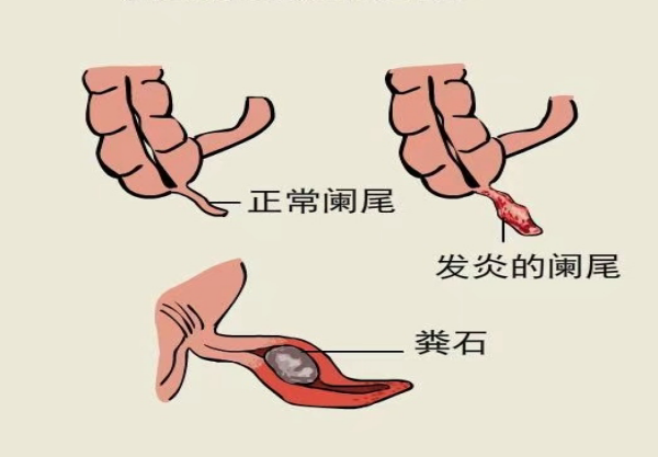 阑尾对我们来说有什么作用呢?