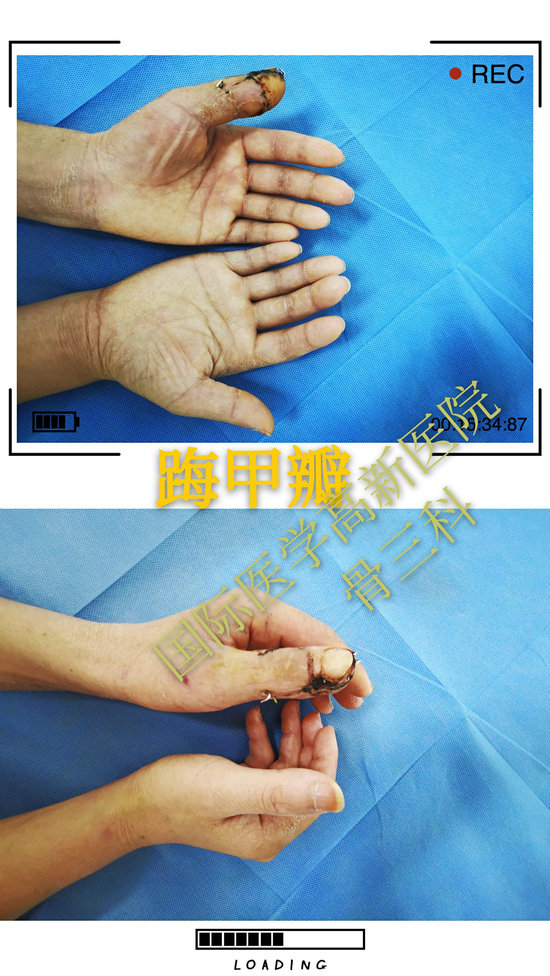 踇甲瓣移植再造手指