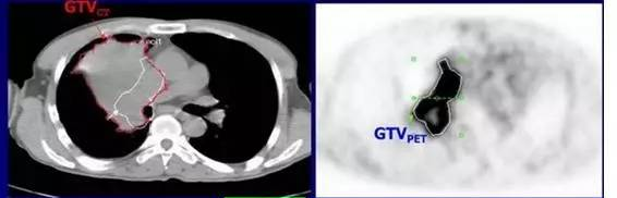 核医学科医生提示肺癌患者进行PET/CT检查的时间节点