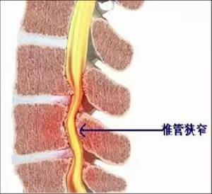 挺起腰杆走路 ！6旬老人术后感言：早知如此，何必多受2年罪