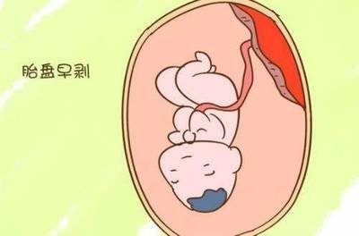 产科危急重症：胎盘早剥