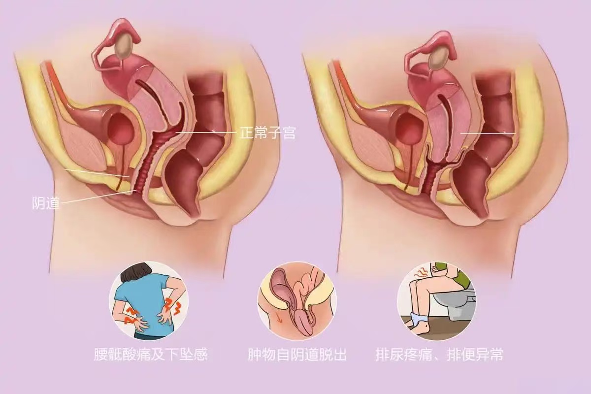 产后盆底肌松弛，除了漏尿，还有哪些尴尬症状？