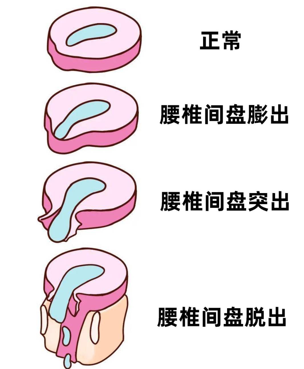 腰椎间盘突出症的康复锻炼