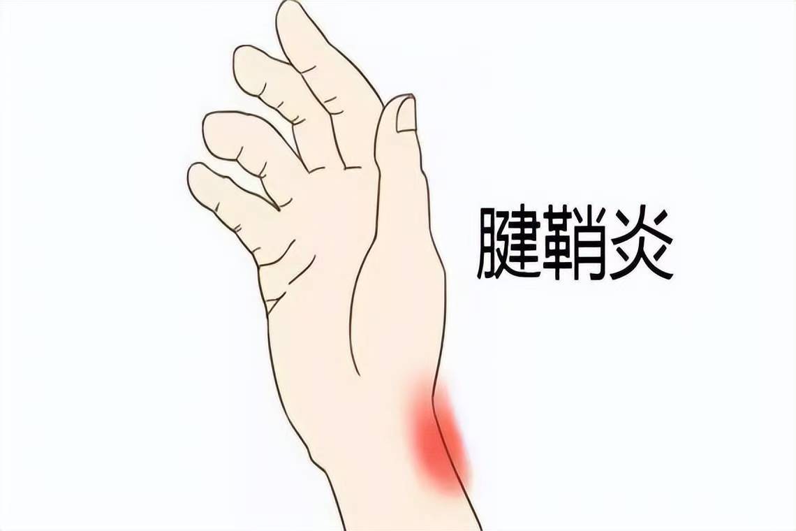 手腕这里痛？当心是腱鞘炎！