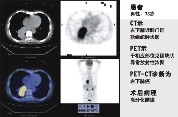 PET-CT的独特功能