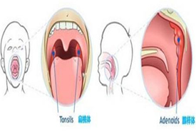 科普知识之儿童“腺样体肥大”