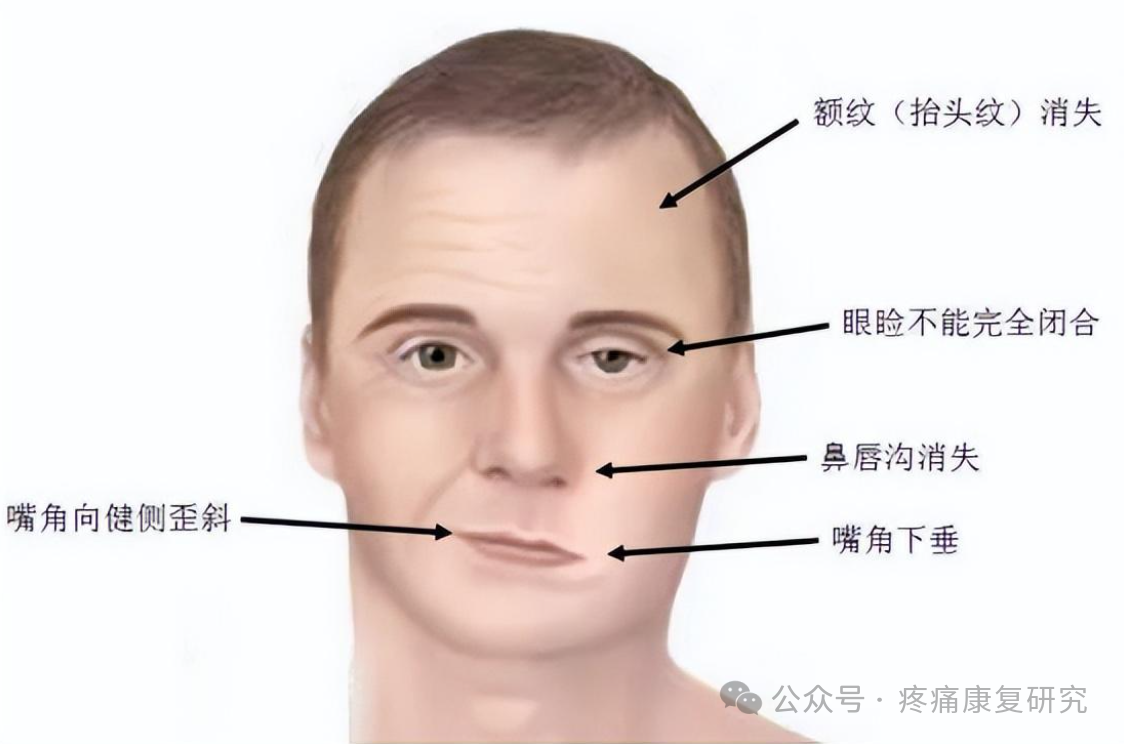 面瘫
