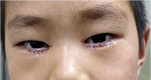 特别是儿童,一旦出现眨眼频繁的问题,一定要到正规医院进行检查.