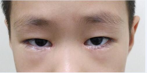 特别是儿童,一旦出现眨眼频繁的问题,一定要到正规医院进行检查.